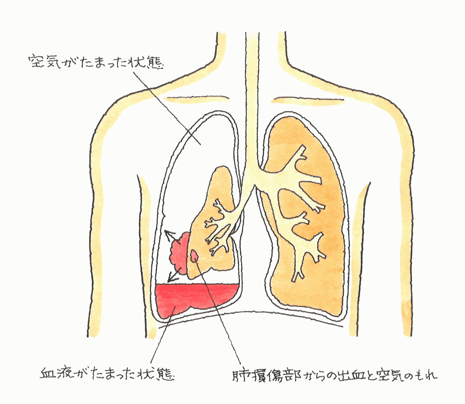 肋骨多発骨折の重症例 外傷性血胸 弁護士による交通事故相談｜弁護士法人前島綜合法律事務所