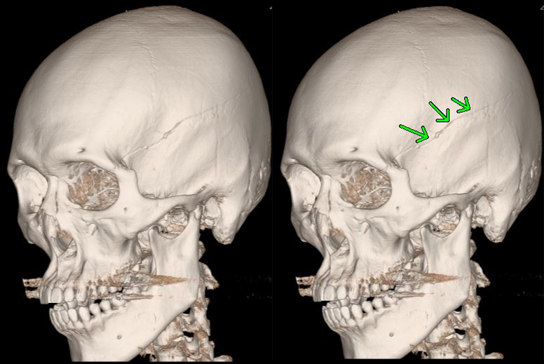 メジカルビュー社入門 頭蓋底手術?側頭骨アプローチのための解剖と手術の実際 鮫島 哲朗