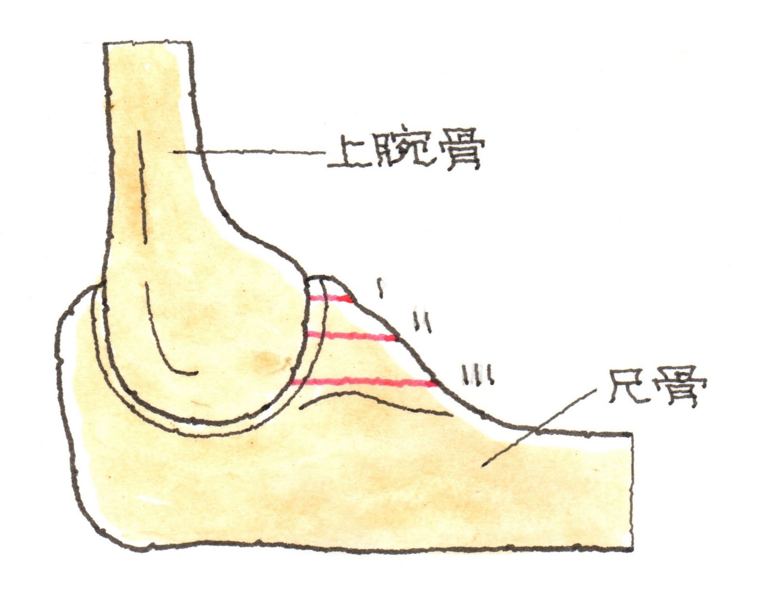 尺骨鉤状突起骨折 （しゃくこつこうじょうとっきこっせつ） 弁護士による交通事故相談｜弁護士法人前島綜合法律事務所
